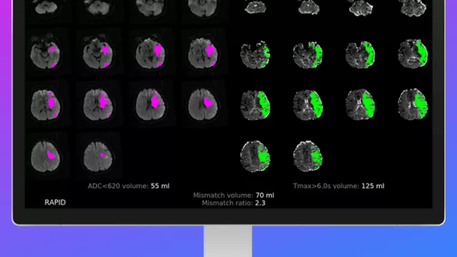 La inteligencia artificial llega a salvar vidas y mejorar secuelas de los ACV (un software que "lee" mejor que los médicos)