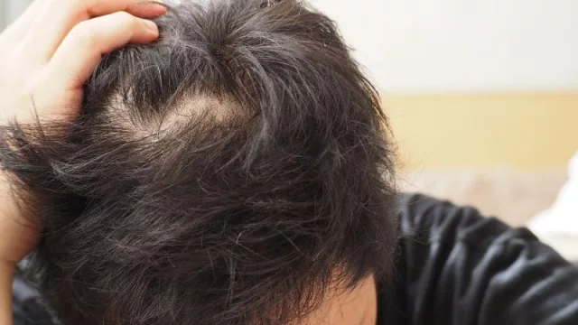 ¿Qué tipo de alopecia tenés? Conocé los diferentes síntomas y encontrá una solución personalizada