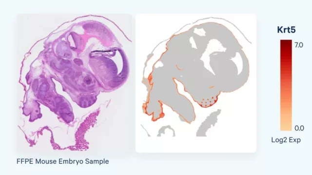 La tecnología Visium HD (de 10x Genomics) elegida por Cure51 para su investigación contra el cáncer