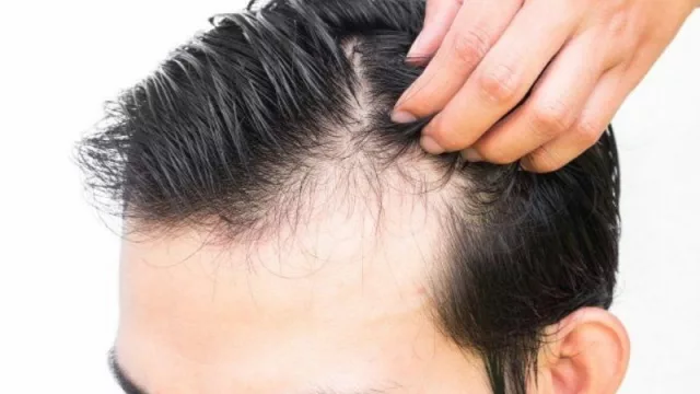 Conocé los preparativos previos a un trasplante capilar, te contamos los pasos sencillos a seguir