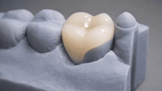 Basta de pernos y coronas: qué es la biomimética (mismo precio que un tratamiento de odontología tradicional)
