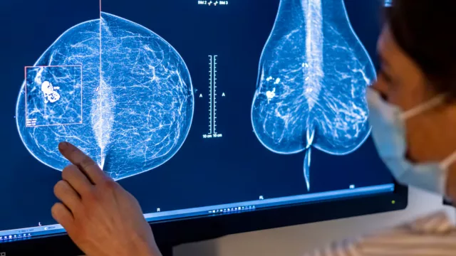 100.000 ojos ven más que 2: la IA ya reduce un 50% el tiempo de análisis de mamografías en la Argentina