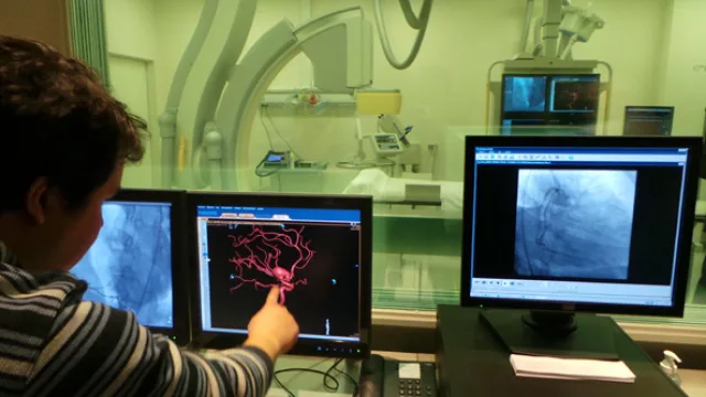La tecnología del diagnóstico por imagen permite visualizar un aneurisma cerebral.
