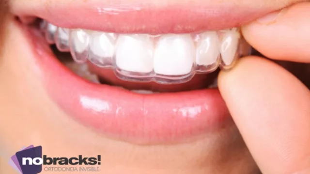 Sobre Nobracks! y su sistema de ortodoncia cordobés
