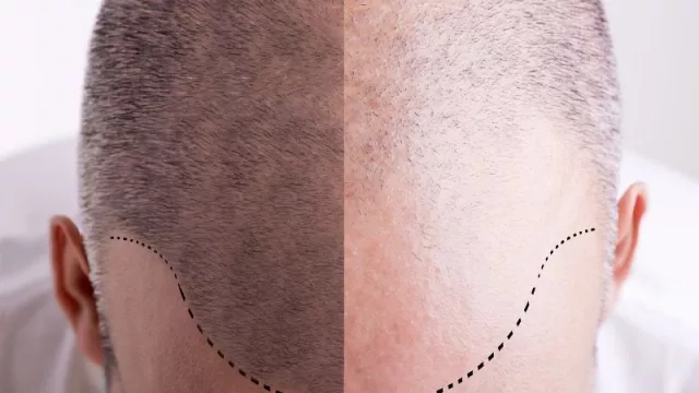 La exactitud que sólo un robot puede lograr, ARTAS para la recuperación capilar